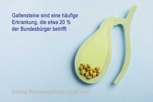 Foto mit Aufschrift: "Gallensteine sind eine häufige Erkrankung, die etwa 20 % der Bundesbürger betrifft"