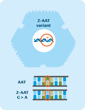 Illustration der Z-AAT-Variante: Oben ein stilisiertes DNA-Symbol mit hervorgehobener Mutation.