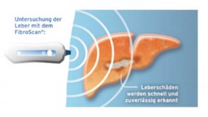Grafik: Fibroscan